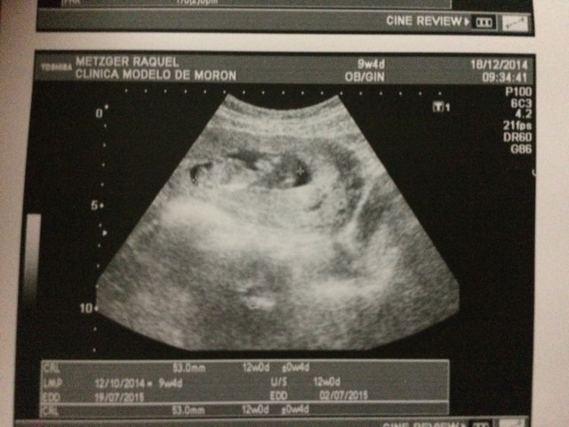 Our first ultrasound at 12 weeks. Baby is growing well.